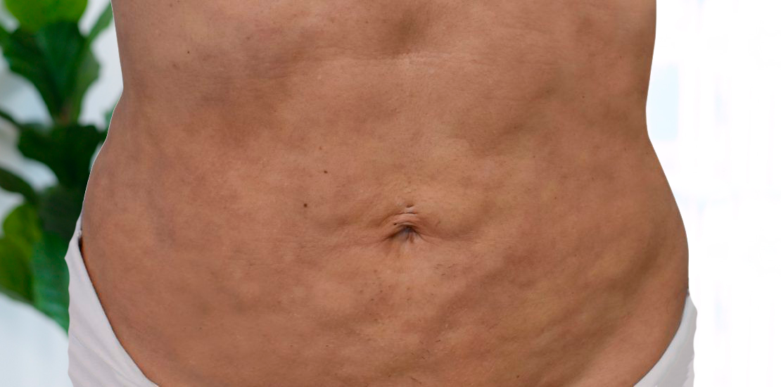 Fibrosis, tratamiento de fibrosis, Kuidarte